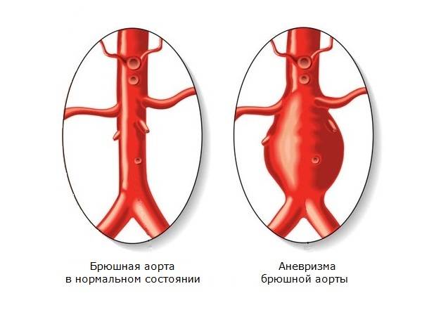 Аневризма брюшного отдела