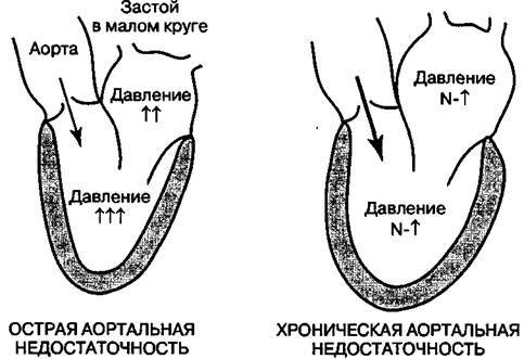 аортальная недостаточность