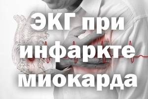 ЭКГ при инфаркте миокарда