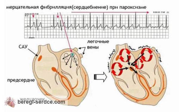 Причины мерцательной аритмии