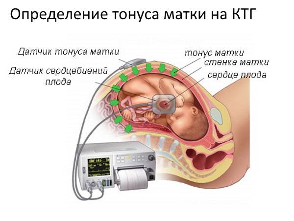 Сердцебиение плода по КТГ