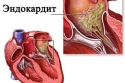 Схема эндокардита