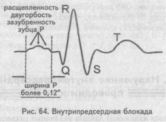 Нарушение внутрипредсердной проводимости что это такое