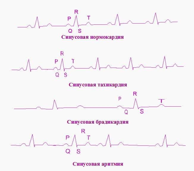 Электрокардиографическая диагностика нарушений сердечного ритма Электрокардиографическая диагностика нарушений сердечного ритма