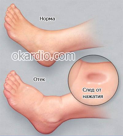 отек ноги