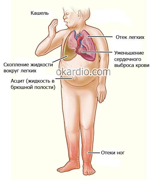 признаки сердечной недостаточности