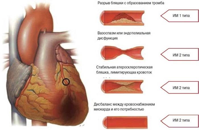 Изменения миокарда