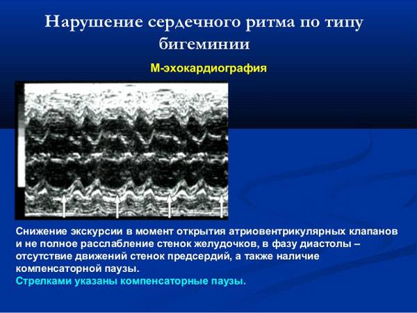 Экстрасистолия по типу бигеминии