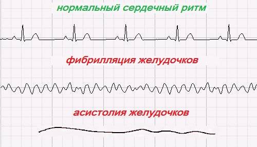Фибрилляция и асистолия желудочков