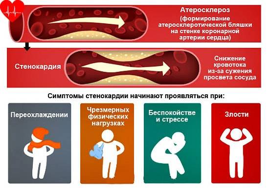 Нестабильная стенокардия симптомы и лечение
