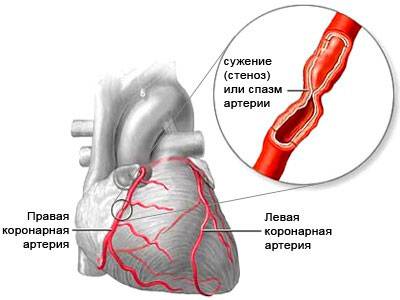 в чем суть стенокардии в чем суть стенокардии