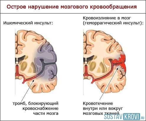 Так выглядит острое нарушение мозгового кровообращения Виды преград в сосудах