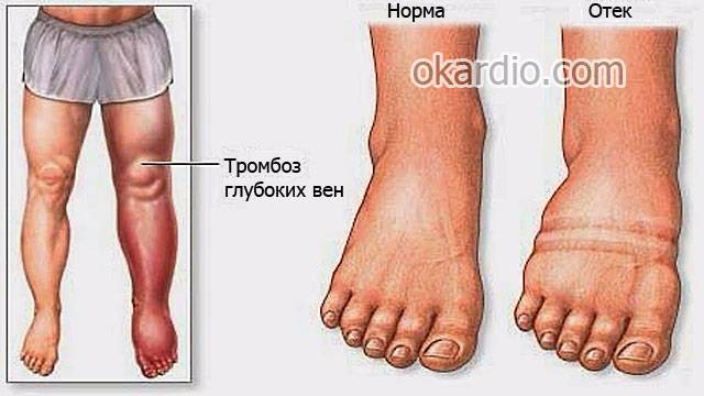 отек ноги при тромбозе глубоких вен