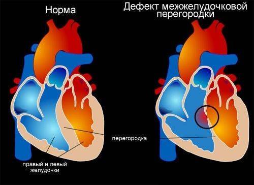 Дефект межжелудочковой перегородки