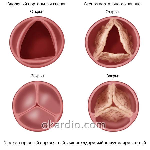 здоровый аортальный клапан и клапан со стенозом