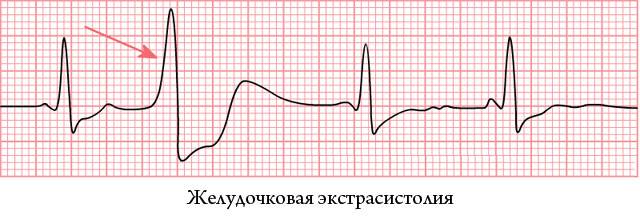 желудочковая экстрасистолия на ЭКГ