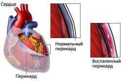 Виды перикардита