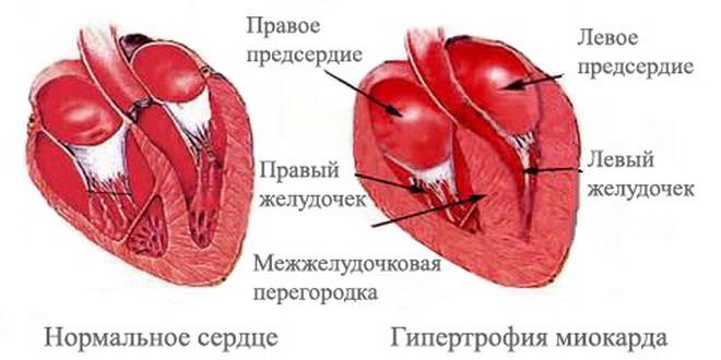 Гипертрофия миокарда