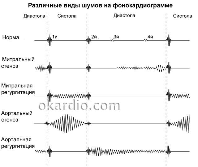 фонокардиограмма с различными шумами сердца