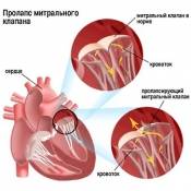 Пролапс митрального клапана и беременность