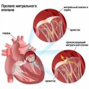 Что такое пролапс митрального клапана сердца: симптомы, лечение, причины