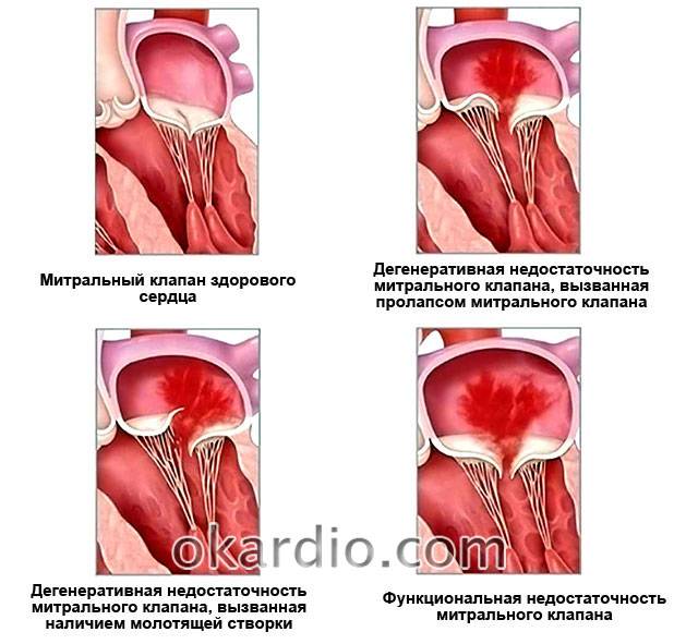 виды пролапса митрального клапана с регургитацией