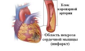 Инфаркт на ногах