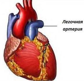 стеноз легочной артерии