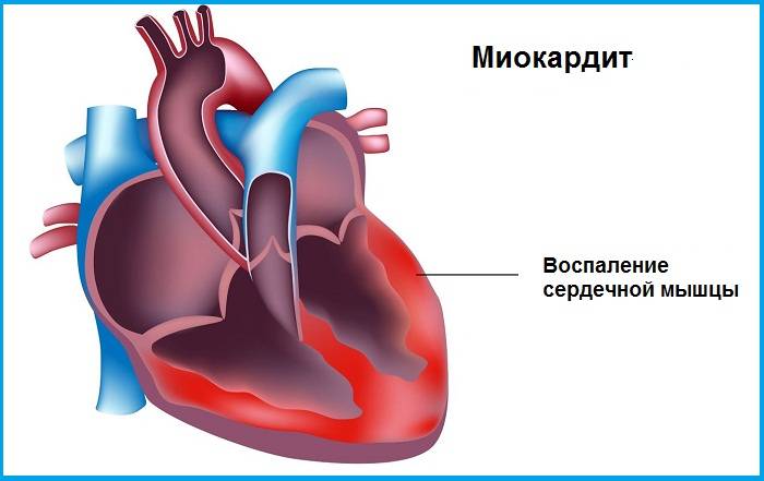 Миокардит