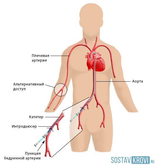 Алгоритм проведения стентирования Проведение