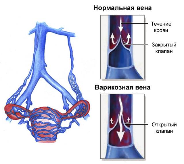 варикозное расширение вен