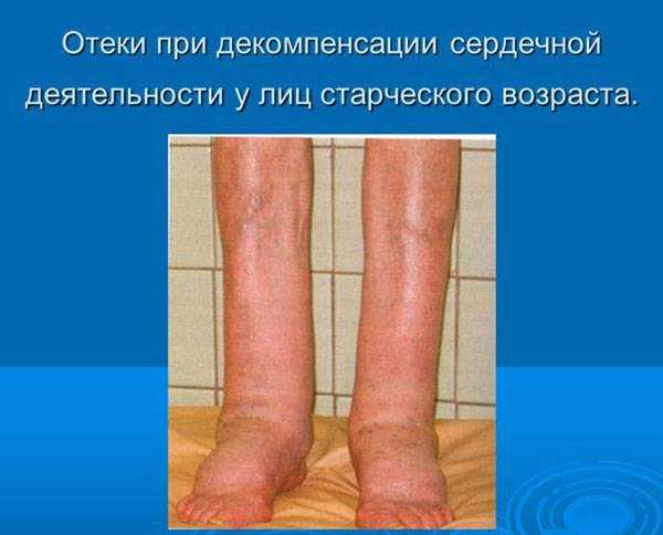 Отеки при сердечной недостаточности