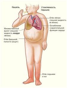 Сердечная отечность