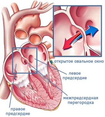 схема окна у ребенка в сердце