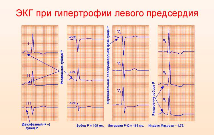 ЭКГ при гипертрофии левого предсердия