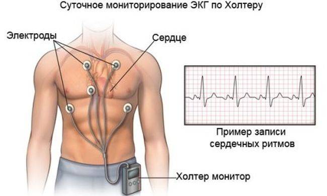 Мониторинг ЭКГ по Холтеру. Мониторинг ЭКГ по Холтеру.