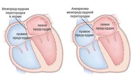 Аневризма межпредсердной перегородки Аневризма межпредсердной перегородки