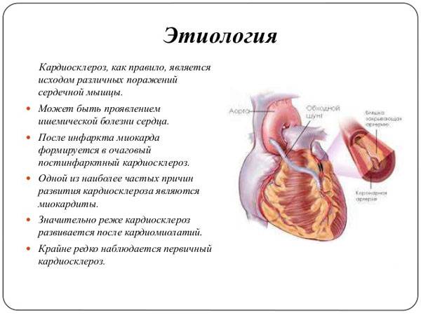 Этиология развития кардиосклероза