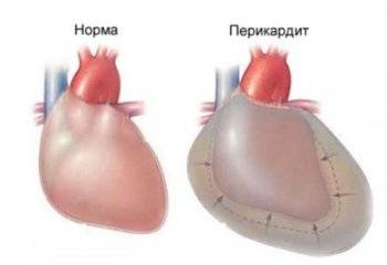 Перикардит симптомы