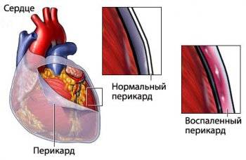 Перикардит симптомы