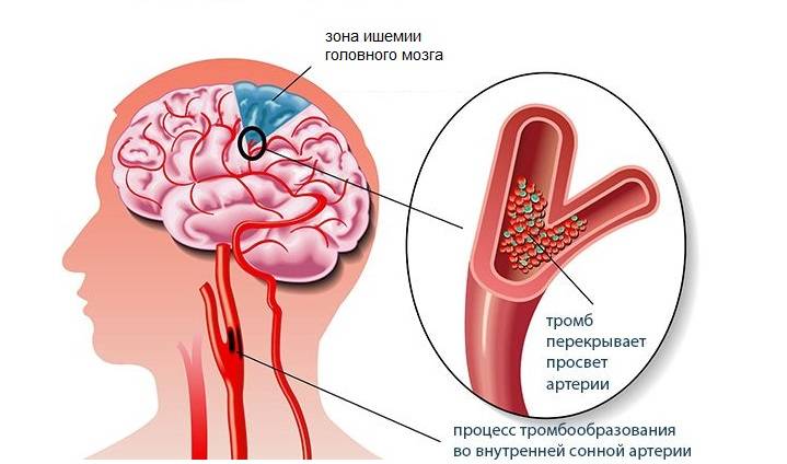 Что такое ишемия головного мозга у человека? Что такое ишемия головного мозга?