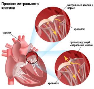 Пролапс митрального клапана: причины, виды, симптомы, диагностика и лечение