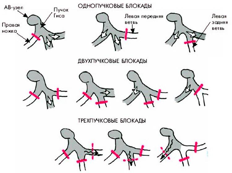 Блокады сердца
