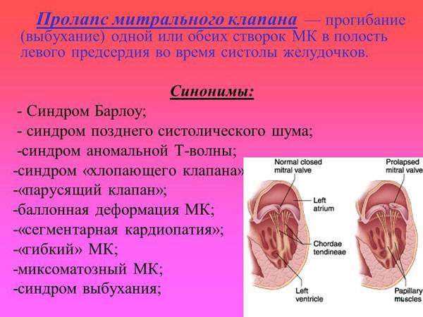 Определение пролапса митрального клапана