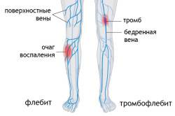 Схема флебита Схема флебита