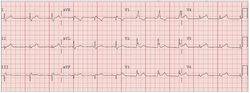 sinusovyj_ritm_pri_ekg_03