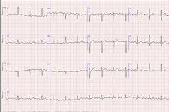 sinusovyj_ritm_pri_ekg_01