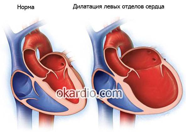 дилатация сердца