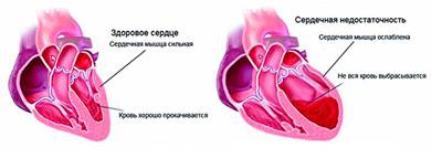 сердце при недостаточности