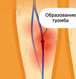 Диагностика тромбофлебита